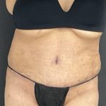 Abdominoplasty Before & After Patient #1070