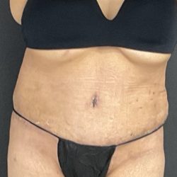 Abdominoplasty Before & After Patient #1070