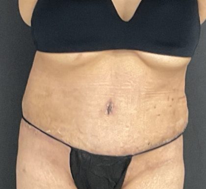 Abdominoplasty Before & After Patient #1070