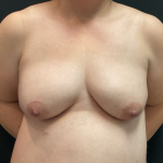 Bilateral Mastopexy and Augmentation Before & After Patient #1181