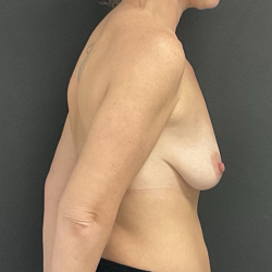 Bilateral Mastopexy and Augmentation Before & After Patient #1192