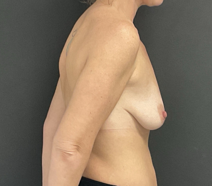 Bilateral Mastopexy and Augmentation Before & After Patient #1192