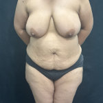 Mommy Makeover Before & After Patient #1285