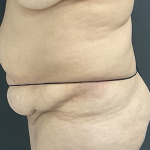 Abdominoplasty Before & After Patient #1297