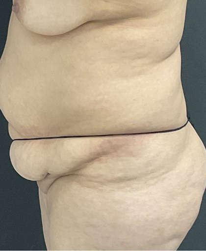 Abdominoplasty Before & After Patient #1297