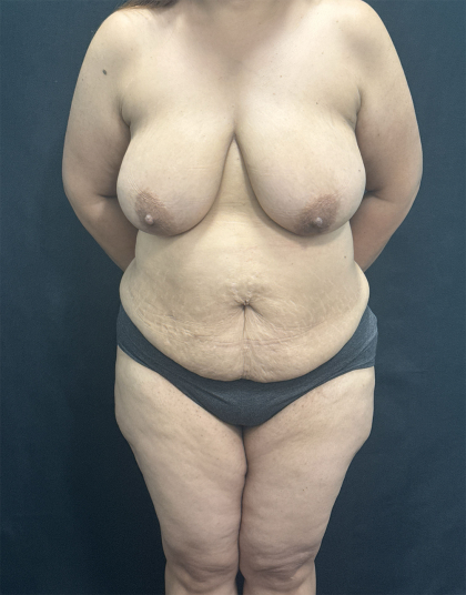 Mommy Makeover Before & After Patient #1285