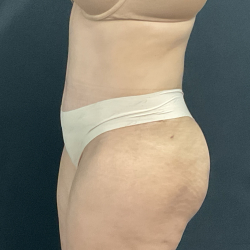 Abdominoplasty Before & After Patient #1286