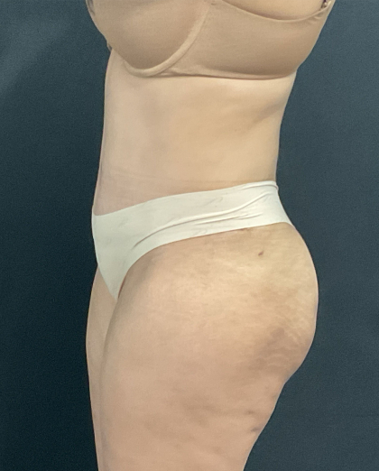 Abdominoplasty Before & After Patient #1286