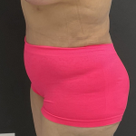 Abdominoplasty Before & After Patient #1297