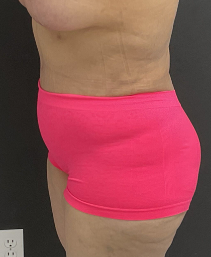 Abdominoplasty Before & After Patient #1297
