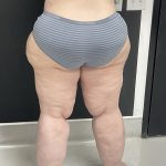 Lipedema Liposuction (Posterior Legs) Before & After Patient #1318
