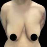 Natural Breast Lift Before & After Patient #1312