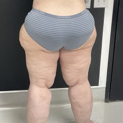Lipedema Liposuction (Posterior Legs) Before & After Patient #1318