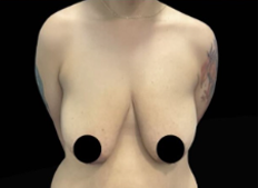 Natural Breast Lift Before & After Patient #1312