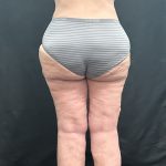 Lipedema Liposuction (Posterior Legs) Before & After Patient #1318