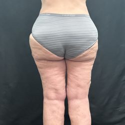 Lipedema Liposuction (Posterior Legs) Before & After Patient #1318