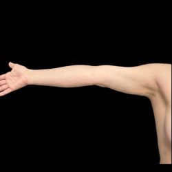 Arm Lipo Before & After Patient #1308