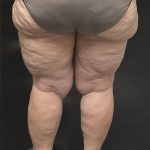 Lipedema Liposuction (Posterior Legs) Before & After Patient #1349