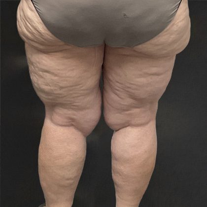Lipedema Liposuction (Posterior Legs) Before & After Patient #1349