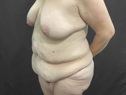 Abdominoplasty Before & After Patient #1346