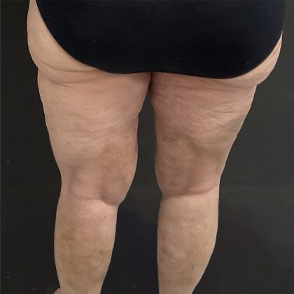 Lipedema Liposuction (Posterior Legs) Before & After Patient #1349