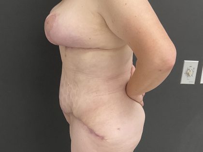 Abdominoplasty Before & After Patient #1346