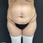 Abdominoplasty Before & After Patient #1378