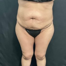 Abdominoplasty Before & After Patient #1446