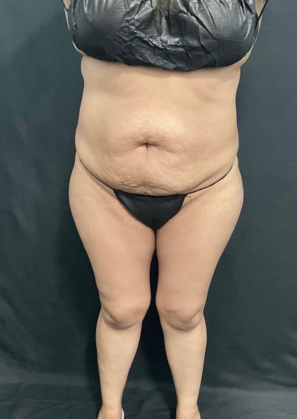 Abdominoplasty Before & After Patient #1446