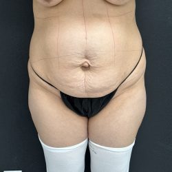 Abdominoplasty Before & After Patient #1378