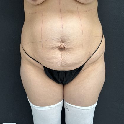 Abdominoplasty Before & After Patient #1378