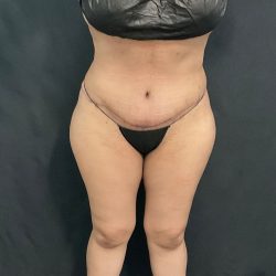 Abdominoplasty Before & After Patient #1446
