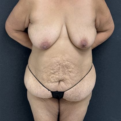 Abdominoplasty Before & After Patient #1383
