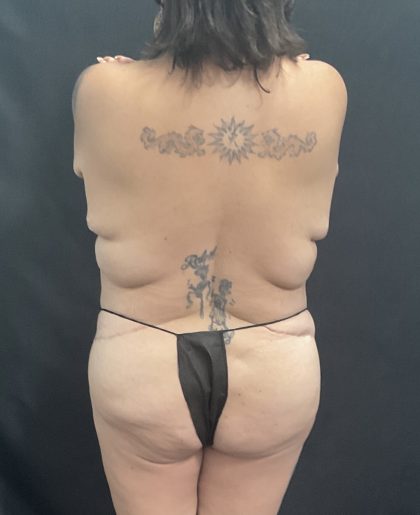 Mommy Makeover Before & After Patient #1417