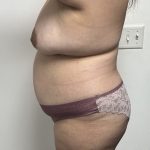 Mommy Makeover Before & After Patient #1404