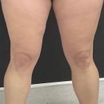 Lipedema Liposuction (Posterior Legs) Before & After Patient #1412