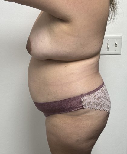Mommy Makeover Before & After Patient #1404