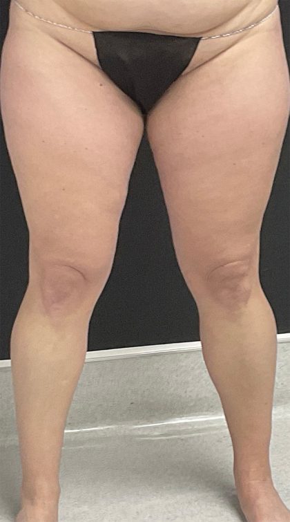 Lipedema Liposuction (Posterior Legs) Before & After Patient #1412