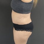 Mommy Makeover Before & After Patient #1404