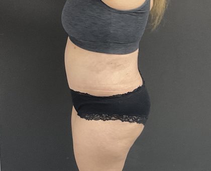 Mommy Makeover Before & After Patient #1404