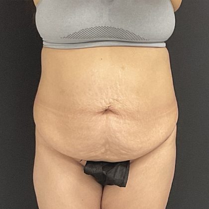 Abdominoplasty Before & After Patient #1373