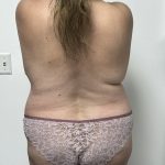 Mommy Makeover Before & After Patient #1404