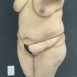 Abdominoplasty Before & After Patient #1447