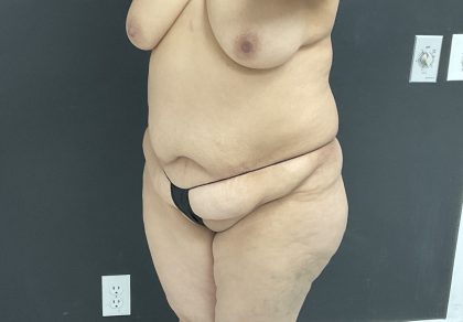 Abdominoplasty Before & After Patient #1447