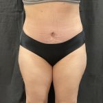 Abdominoplasty Before & After Patient #1378