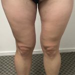 Lipedema Liposuction (Posterior Legs) Before & After Patient #1412