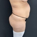 Abdominoplasty Before & After Patient #1378