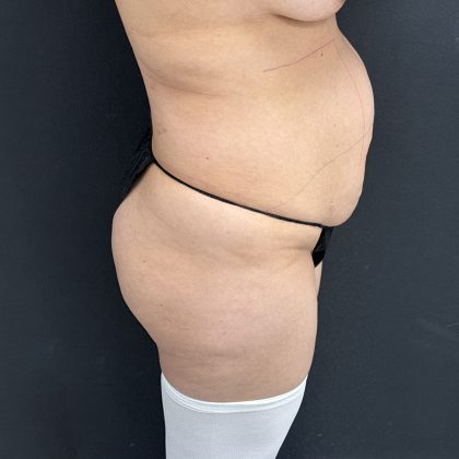 Abdominoplasty Before & After Patient #1378