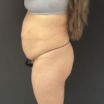 Abdominoplasty Before & After Patient #1373