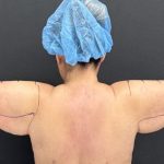 Arm Lift Before & After Patient #1449